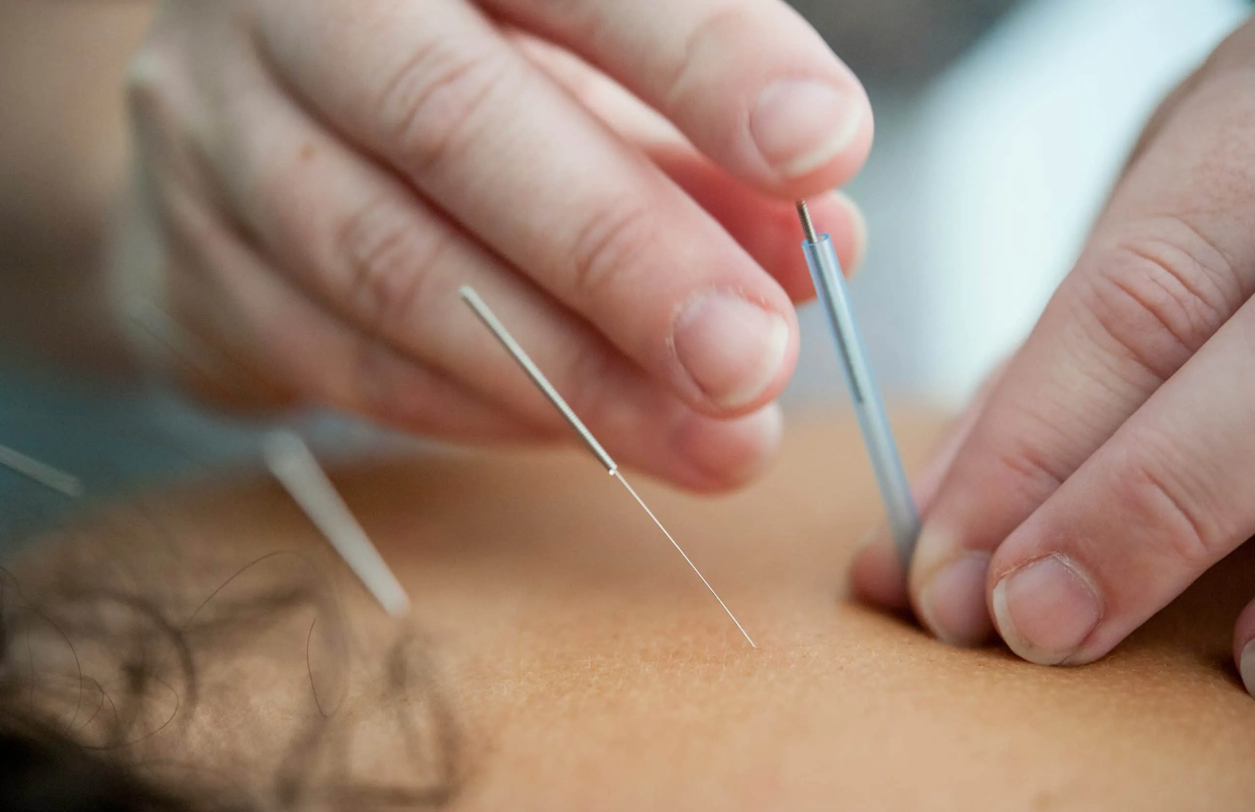 Dry needling and acupuncture